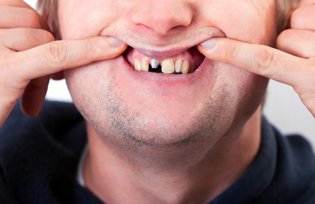 patient showing his El Dorado Hills dental implants