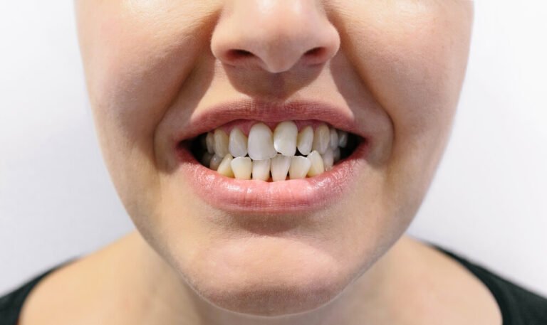 Top Questions Asked About Crooked Teeth