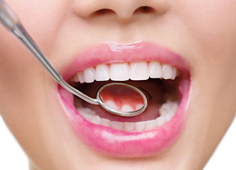 Most Asked Questions About Dental Sealants