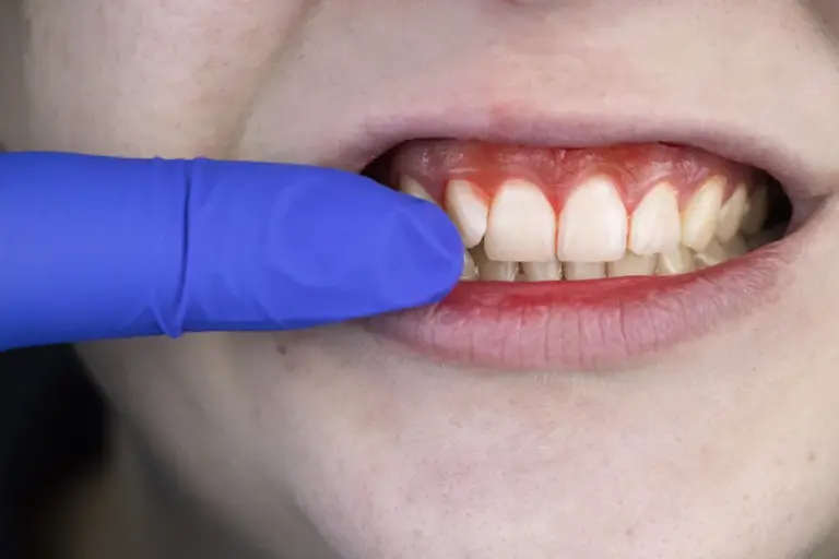 Dealing With Bleeding Gums? Visit a Dentist in Rescue CA