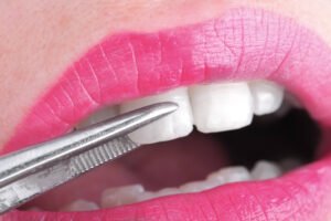 an expert in Cameron Park Cosmetic Dentistry installing a veneer