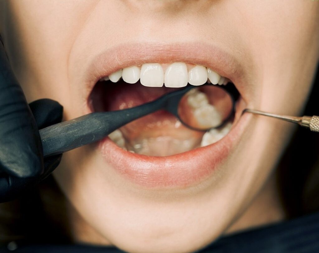 Composite Fillings - Forest Ridge Dental Group