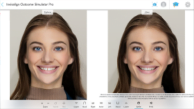 Invisalign® tool slide-1
