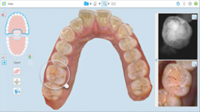 Invisalign® tool slide-2