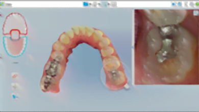 Invisalign® tool slide-3